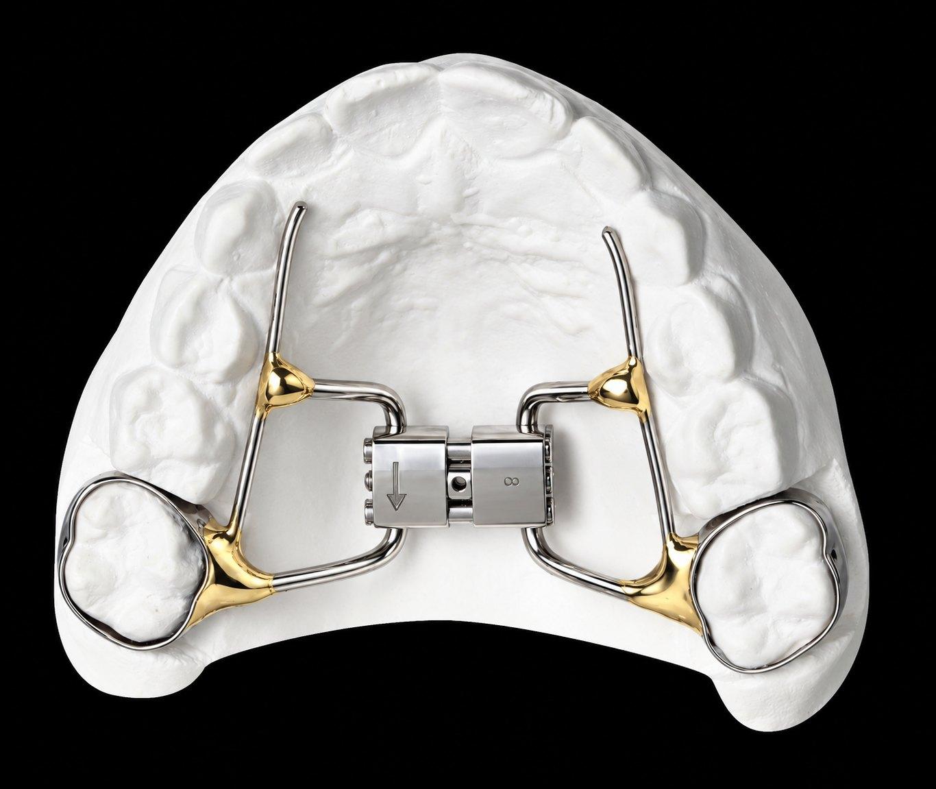 Rapid palatal expander on a white model